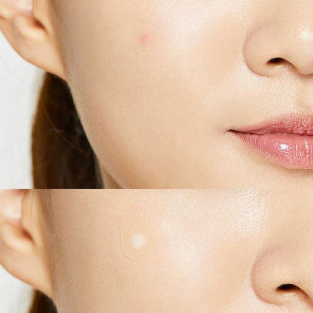 COSRX Acne Pimple Master Patch 26 Patches – Selbstklebende Pickelpflaster