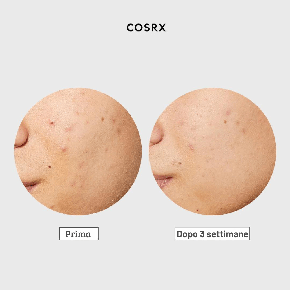 COSRX AC Collection Ultimate Spot Cream for Inflammation - Trattamento localizzato acne 30gr - Cosrx | Paradea