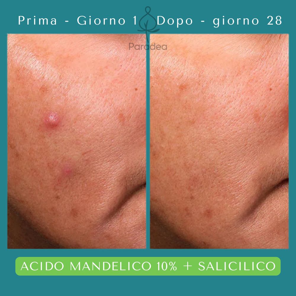 O Boticário Botik Sérum de Alta Potência Ácido Mandélico 10% + Salicílico - Siero viso 30ml - o Boticário | Paradea